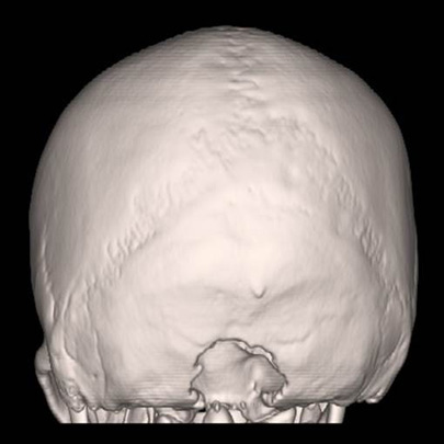 Taken after minimally invasive decompression surgery, this CT scan shows the area where bone was removed.