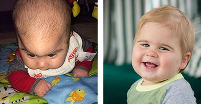 Leo Schwadron Craniosynostosis before and after